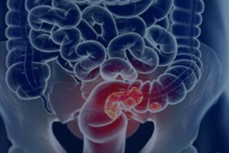 rastreamento-para-cancer-colorretal-pode-ser-implementado-no-sus